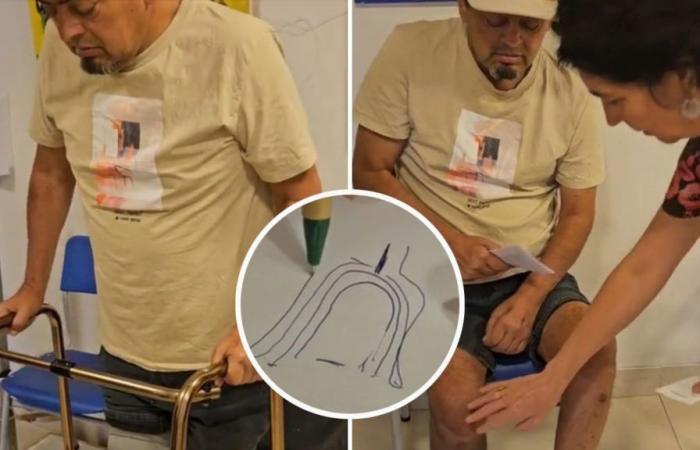 Mauricio Medina ha celebrato l’installazione della sua protesi ortopedica in un video emozionante